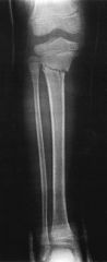 Hx:5yo G falls off of a trampoline & sustains a tibia fx. The tibia fx is reduced & placed into a LLC in the ER. A post-reduction xray is provided in Fig A. The parents should be counseled that a temporary tibial deformity may occur. Which best de...