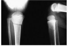 Pediatric proximal tibia metaphyseal fractures, or Cozen fractures, heal reliably but often progress to a valgus deformity. The valgus deformity seen with Cozen fractures is secondary to an increase in metaphyseal growth medially.However, the affe...
