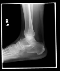 Tarsal coalition, most commonly occurring as a talocalcaneal or calcaneovnavicular coalition, is the leading cause of peroneal spastic flatfoot and leads to a rigid pes planus deformity of the foot,  "C-sign", which is shown in Illustration A. Thi...