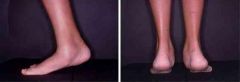 Hx;10yo M c/o 6 mths of b/l foot pain @ the tarsal sinus. Clinical images of standing exam & heel rise in Fig A & B xray L foot Fig C & D. Which of the following findings  is assoc w/ this patient's condition? 1-Dynamic supination during swing pha...