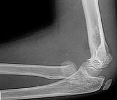 Hx:10yo B c/o injury to his dominant elbow & presents to the ED w/ the injury Fig A & B. Following CR and casting, the fx remains angul 20 deg & translated 2mm. What is the next step in managt?  1-Immob in full pronation; 2- Immob in full supinati...