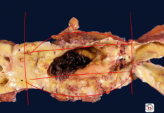 Abdominal aortic aneurysm below renal arteries, above bifurcation
-notice ballooning