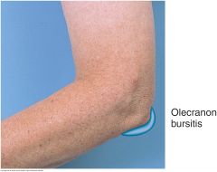 Swelling and inflammation of the olecranon bursa may results from trauma, gout, or rheumatoid arthritis. The swelling is superficial to the olecranon process and may reach 6 cm in diameter. Consider aspiration for both diagnosis and symptomatic re...