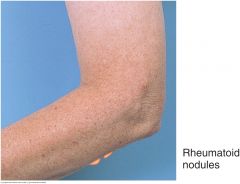 Subcutaneous nodules may develop at pressure points along the extensor surface of the ulna in patients with rheumatoid arthritis or acute rheumatic fever. They are firm and nontender. They are not attached to the overlying skin but may be attached...