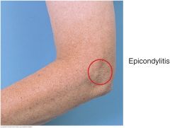 Lateral epicondylitis (tennis elbow) follows repatitive extension of the wrist or pronation-supination of the forearm. Pain and tenderness develop 1 cm distal to the lateral epicondyle and possibly in the extensor muscles close to it. When the pat...