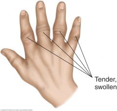 Tender, painful, stiff joints in rheumatoid arthritis, usually with symmetric involvement on both sides of the body. The PIP, MCP and wrist joints are the most frequently affected. Note the fusiform or spindle-shaped swelling of the PIP joints in ...