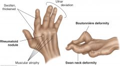 In chronic disease, note the swelling and thickening of the MCP and PIP joints. ROM becomes limited, and fingers may deviate toward the ulnar side. The interosseous muscles atrophy. The fingers may show "swan neck" deformities (hyperextension of t...