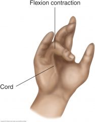 Flexion contractures in the ring, fifth, and third fingers arise from thickening of the palmar fascia


 


First sign s a thickened nodule overlying the flexor tendon of the ring finger and possibly the little finger near the distal palmar c...