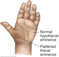 Suggests a median nerve disorder such as carpal tunnel syndrome. Hypothenar atrophy suggests an ulnar nerve disorder.


 