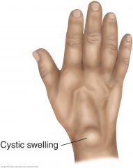 Ganglia are cystic, round, usually nontender swellings along tendon sheaths or joint capsules, frequently at the dorsum of the wrist. The cyst contains synovial fluid arising from erosion or tearing of the joint capsule or tendon sheath and trappe...