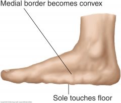 Signs of flat feet may be apparent only when the patient stands, or they may become permanent. The longitudinal arch flattens so that the sole approaches or touches the floor. The normal concavity on the medial side of the foot becomes convex. Ten...
