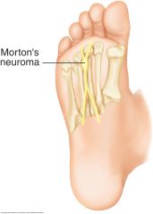 Look for tenderness over the plantar surface between the third and fourth metatarsal heads, from perineural fibrosis of the common digital nerve due to repetitive nerve irritation (not a true neuroma). Check for pain radiating to the toes when you...