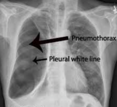 Air entry into pleural cavity
1. trauma (bullet wound, stab)- thoracic wall opening
2. bronchopulmonary fistula- a communication between lung &
pleural cavity //congenital

Treatment: pleurodensis