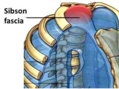 thickened endothoracic fascia protects cervical pleura/cupula that is prone to injuries above first rib to C7