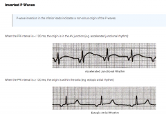 A


 


Junctional rhythm or ectopic pacemaker


 


Ref: LITFL