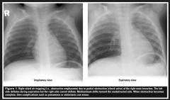 B



RCH CPG – Inhaled Foreign Body

Look for:

• an opaque foreign body

• segmental or lobar collapse

• localised emphysema in expiration (ball valve obstruction)

• The CXR may be normal



Rovin JD, Rodgers BM. Pediatric fo...