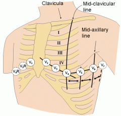 Chest lead placed at the same horizontal level as V4, this lead is placed at the anterior axillary line