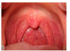 Inflamed pharyngeal mucosa/adenoid glands