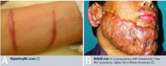 -Hypertrophic; increased collagen synthesis, confined to the boarders of the original wound and infrequently recurs following resection
-Keloid; larger increase in collagen synthesis, extends beyond original wound, frequently recurs following res...