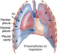 3. Pneumothorax: the presence of air or gas in the pleural space caused by: