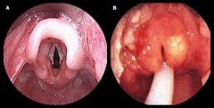 8a. Epiglottis