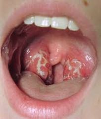 9. Tonsillar infections