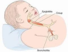 10 Bronchiolitis etilogy