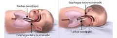 11. SIDS
      *Etiology