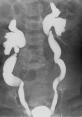 

A 1-year-old girl is investigated for recurrent urinary tract infections. A micturating cystourethrogram is ordered: What does this image demonstrate?