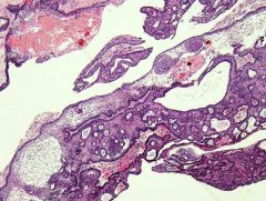 This squamous cell lesion located in the suprasellar space represents?