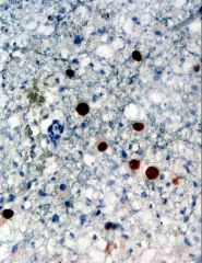 Inclusion associated with demyelinating disease is identified with what immunostain?