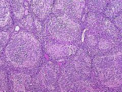 Genetic abnormality associated with this neoplasm?