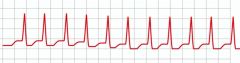 Paroxysmal supraventricular tachycardia (PSVT - shown), specifically narrow complex tachycardia or supraventricular tachycardia (SVT) with aberrancy; AV nodal arrhythmias (adenosine causes transient AV block). Note: synchronized cardioversion and ...