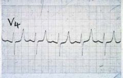 •  Flattened P waves
•  widened QRS complex
•  peaked T waves
•  sine waves
•  ventricular fibrillation