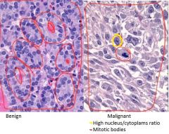 -Determined by degree of differentiation and mitotic activity (histologically)