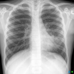 

An 11-year-old girl presents with a productive cough and fever. A chest x-ray is taken: main finding on the XR?