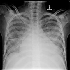 

A 10-year-old girl is admitted with shortness-of-breath and fatigue. A chest x-ray is performed on admission: 

Based on the x-ray findings, what is the most likely diagnosis?