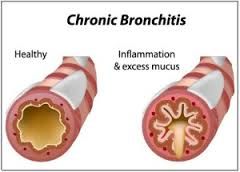 5e. Chronic bronchitis
