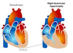 Secondary to Pulmonary Artery Hypertension and will cause signs of right sided heart failure > Right ventricular enlargement…because right ventricle has to work harder to pump blood into the lung.
