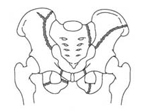 Name the type of pelvic fracture with mortality, blood loss and complication rate.