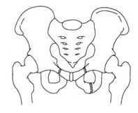 Name the type of pelvic fracture with mortality, blood loss and complication rate.