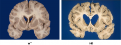 Brain on the right is from a patient who suffered from?