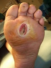 - caused by a combination of artery disease (ischemia) and nerve disease (neuropathy) - can lead to ulcers/infections and may require amputation
- with neuropathy, the patient does NOT feel pain, so repetitive injuries go unnoticed and ultimately...