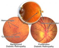 1. approx 75% after 20 years of diabetes. Annual screening by an ophthalmologist is recommended.
2. Background/nonproliferative retinopathy accounts for the majority of cases. Fundoscopic exam shows hemorrhages, exudates, microaneurysms and venou...
