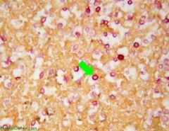 Consequences of meningeal infection caused by the organisms shown in the above mucicarmine stain include ?