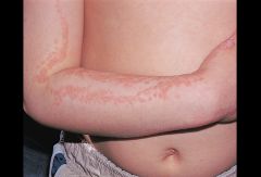 rash that looks like eczema, but is linear or papular and can follow the Lines of Blaschko