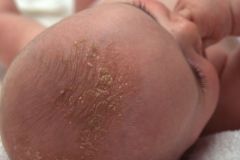 erythema with greasy yellowish scales, usually on scalp in infants

treat with selenium sulfide or ketoconazole