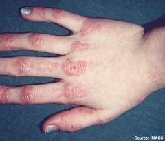 periorbital heliotropic rash

gottron papules - flat-topped reddish-violet skin over the knuckles