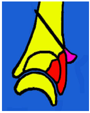 Fr. marginală posterioară radială – prin felxia mânii şi pronaţie; Fixare cu broşă şi imobilizare pe atelă gipsată