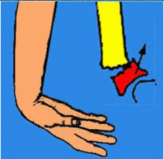 Fr. epifiză distală radius – cădere pe mână în hiperflexie – deplasare longitudinală, anterioară, laterală; Aspectul mâinii în “burtă de furculiţă”